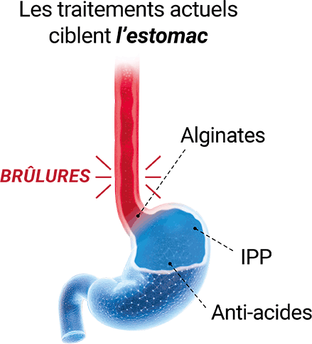 Les traitements actuels ciblent l’estomac
